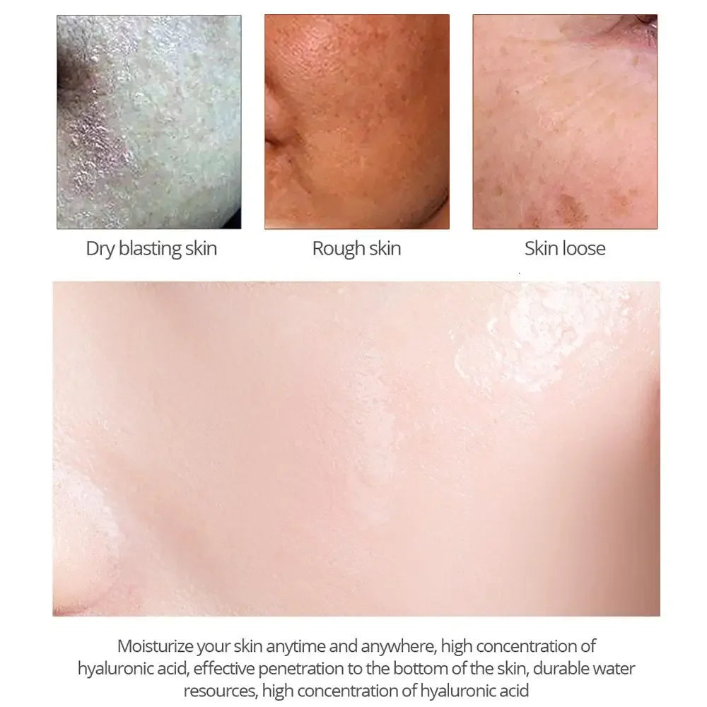 Whitening Freckles Cream Remove Melasma Dark Spot Lightening are