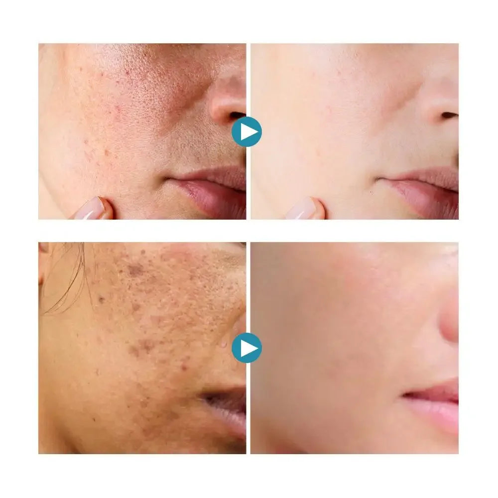 Whitening Freckles Cream Remove Melasma Dark Spot Lightening are