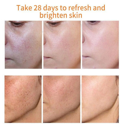 Whitening Freckles Cream Remove Melasma Dark Spot Lightening are